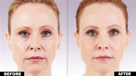 Juvederm Ultra Ultra Plus Voluma Horizon Dermatology Cosmetic