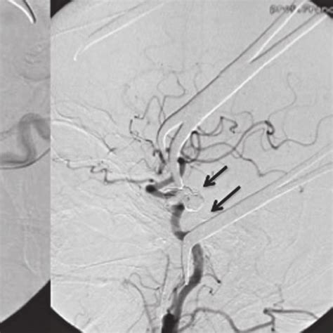 Left Common Carotid Artery Angiogram In Anterior Posterior View A And