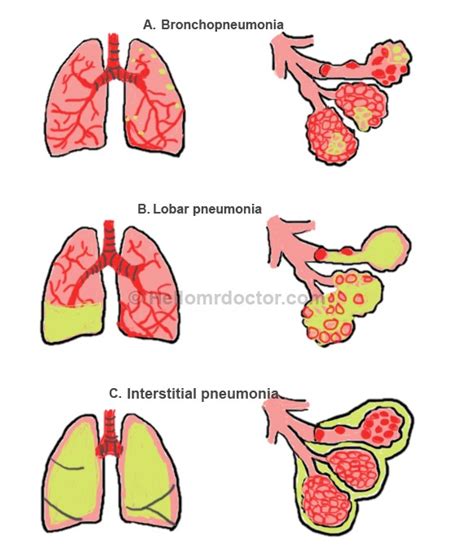 Bronchopneumonia Symptoms Pathophysiology Diagnosis Treatment