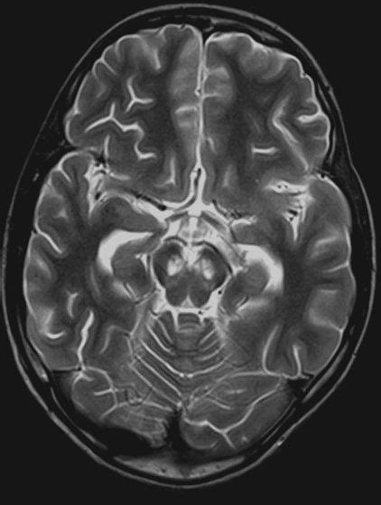 T2 Weighted Axial Magnetic Resonance Imaging Showing Bilateral Isolated