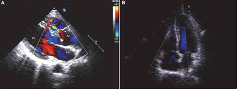 Frontiers | Case report: Total thoracoscopic repair of sinus of
