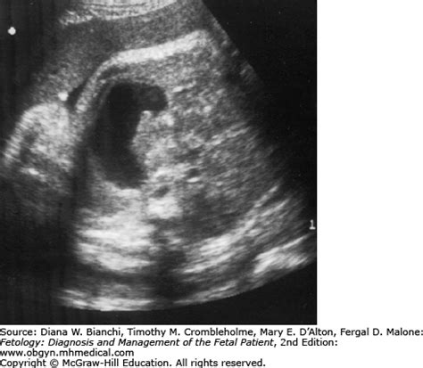 Pyloric Atresia and Stenosis | Obgyn Key