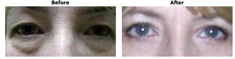 4 Lid Blepharoplasty Ny Eyelid Specialist Dr Debra Kroll