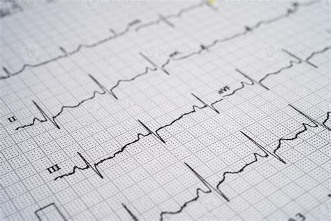 électrocardiogramme ecg avec coeur rouge onde cardiaque crise