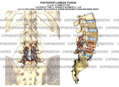 Lumbar Laminectomy And Fusion