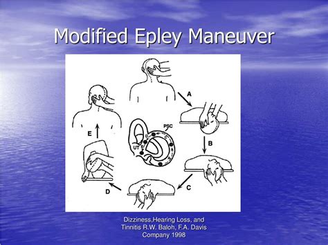 Epley Maneuver Image