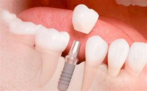 Que Son Los Implantes Dentales Implantes Dentales Dental Protesis