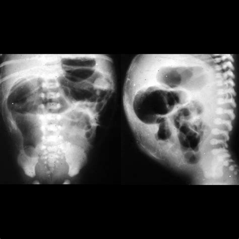 Complicated Meconium Ileus | Pediatric Radiology Reference Article ...