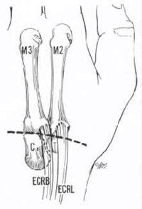 Carpal Tunnel Syndrome - Hand Conditions - Hand Orthopedic Specialists ...