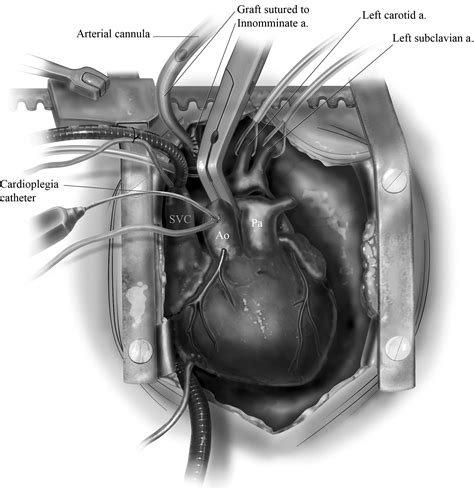 Anatomic Repair of Recurrent Aortic Arch Obstruction - Operative