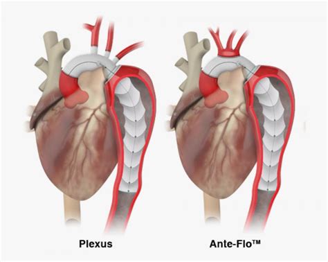 Global Vascular Grafts Market Overview And Industry