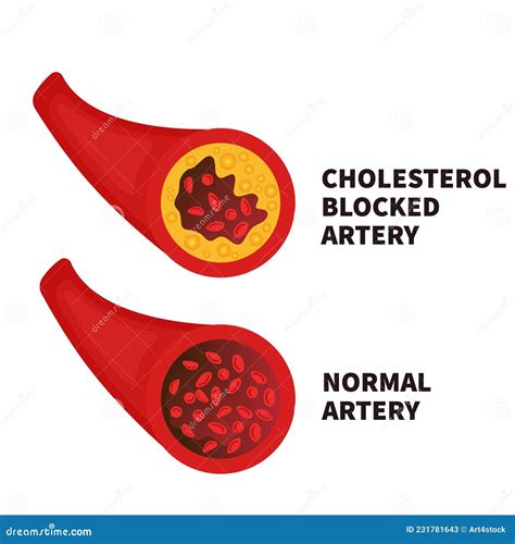 Hyperlipidaemia Stock Illustrations – 6 Hyperlipidaemia Stock