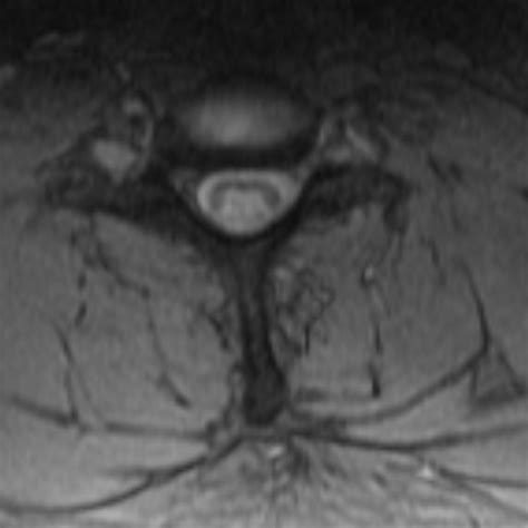 Subacute Combined Degeneration Of The Spinal Cord Image