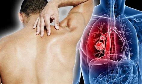 Simptome Ale Cancerului Pulmonar Naturamed