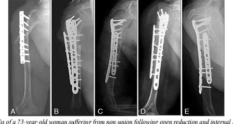 Figure 2 From Orthogonal Double Plate Fixation For Long Bone Fracture