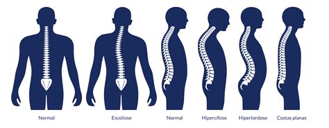 Patologia Osteomioarticular Em Diferentes Segmentos Da Coluna