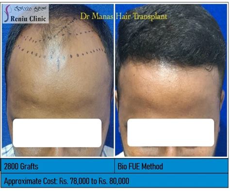 Hair Transplant Cost In Mysore Calculate Hair Grafts Reniu Clinic