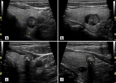 Thyroid Nodule Ultrasound