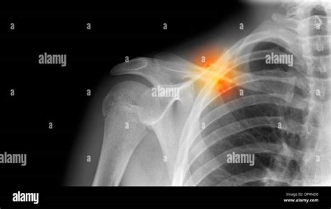 Collarbone X Ray High Resolution Stock Photography and Images - Alamy