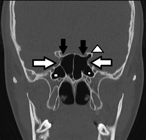 Association Of Accessory Sphenoid Septa With Variations In Neighbouring