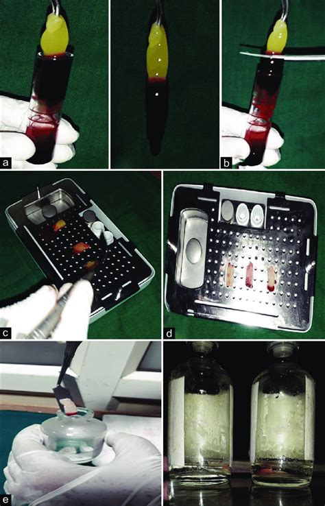 Preparation Of Modified Advanced Platelet Rich Fibrin Membrane A