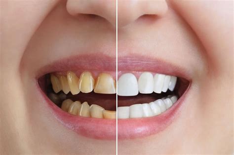 Before And After Real Life Cosmetic Dentistry Transformations