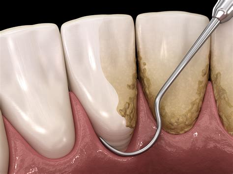 Scaling Root Planing North Dallas Dental Health