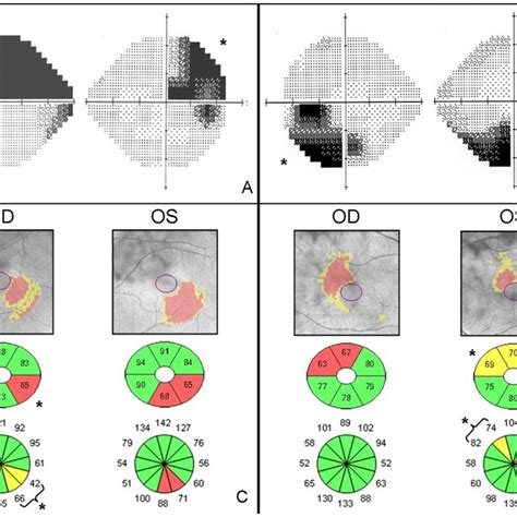 Clinical Features Of Patients With Visual Field Defects Secondary To