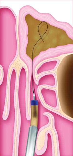 Balloon Sinus Dilation Sinusitis Treatment Great Neck Nassau