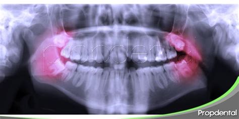Riesgos En La Extracci N De La Muela Del Juicio