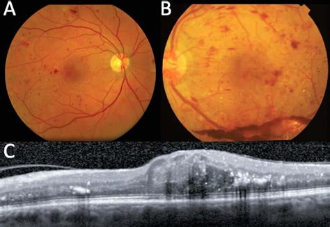 Diabetic Retinopathy Doctors | Diabetic Eye Specialists in San Diego