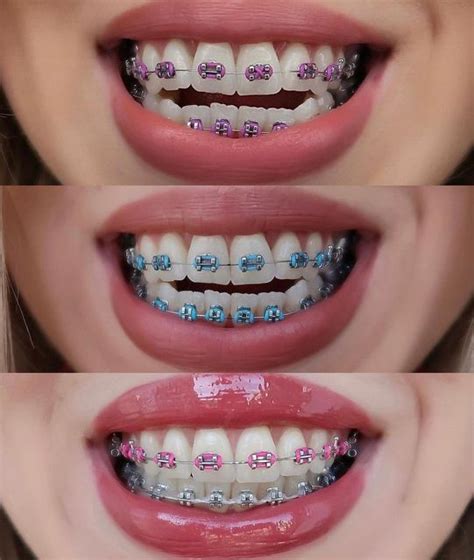 Behel Braces Alat Perapih Gigi On Instagram Rahasia Gigi Berantakan