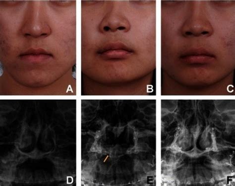 Diagnosis Deviasi Septum Nasal Alomedika