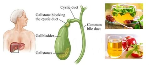 Here Is How To Dissolve Gallstones With The Best Home Remedies Women Daily Magazine