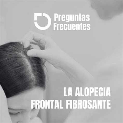 Preguntas Y Respuestas Sobre La Alopecia Frontal Fibrosante Dermilid