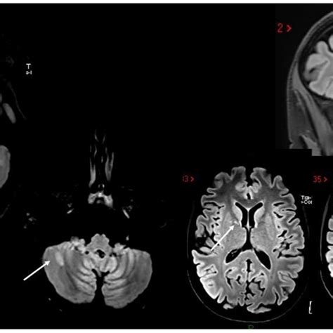 White matter lesions in both supratentorial and infratentorial regions ...