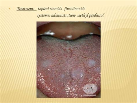 Diseases of tongue