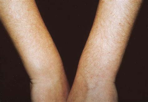 Hypertrichosis Journal Of The American Academy Of Dermatology