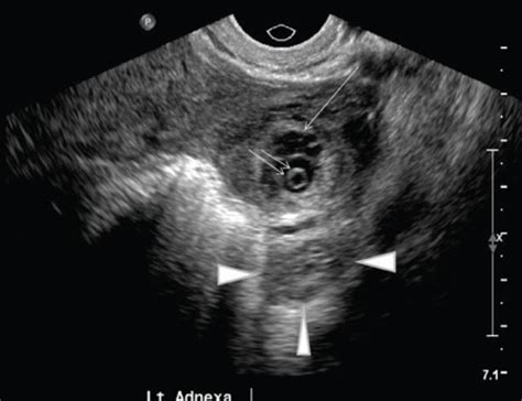 Chp Sonographic Assessment Of Ectopic Pregnancy Flashcards Quizlet