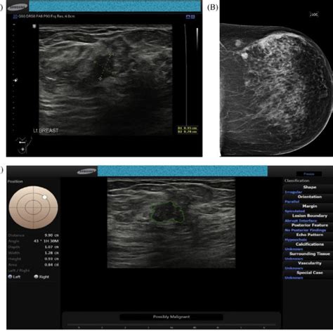 A 45 Year Old Woman With A Palpable Lump In The Left Breast Ultrasound