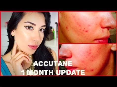 Accutane Journey My Month Update Results Symptoms Side