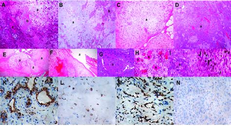 Histological Features And Immunostaining For P16 In Pa A Classic Download Scientific Diagram