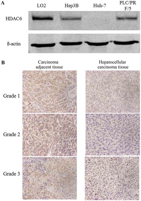 Overexpression Of Hdac Suppresses Tumor Cell Proliferation And