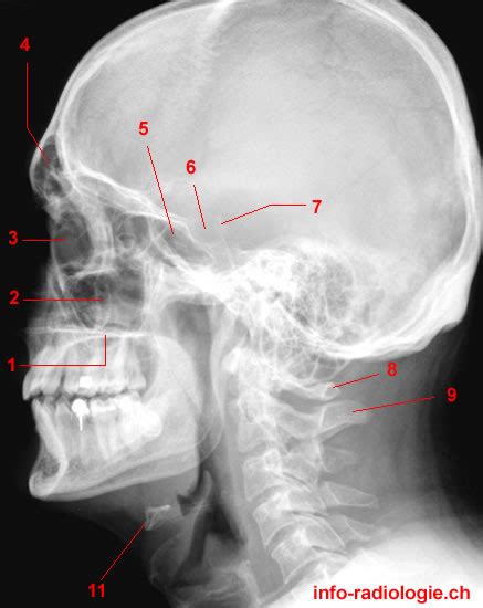 Paranasal Sinuses X Ray