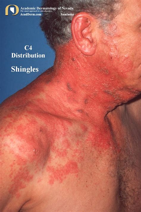 Shingles On Neck