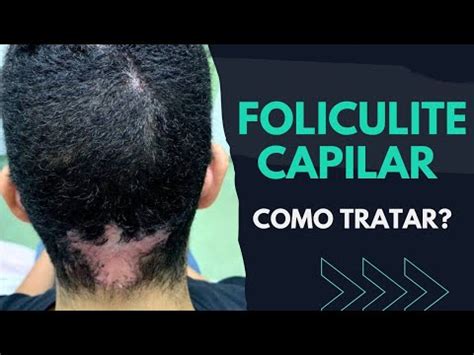 FOLICULITE CAPILAR Como Tratar SAIBA NESSE VÍDEO YouTube