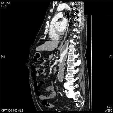 Contrast Enhanced Ct Of Abdomen Sagittal Reconstruction Shows