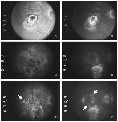 Recurrent Choroidal Neovascularization After Macular Translocation