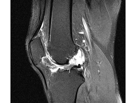 Lesiones Del Ligamento Cruzado Anterior LCA