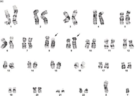 Chapter 13 Myeloid And Lymphoid Neoplasms Associated With